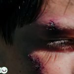 Dream Interpretation of Wound In Islam